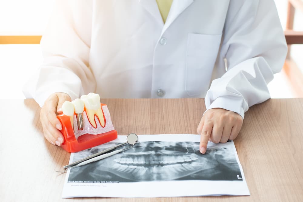dentist-with-dental-implant-model-LAEP9QC (1)